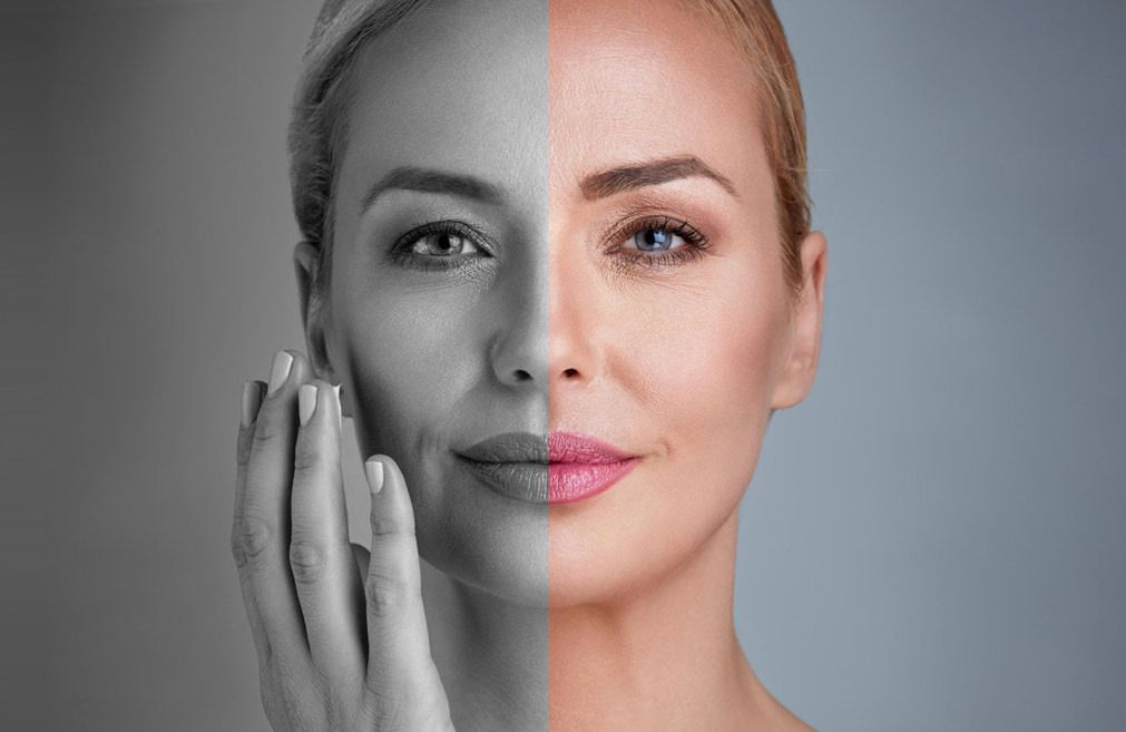 LANACRE Before and After - Wrinkle Reduction
