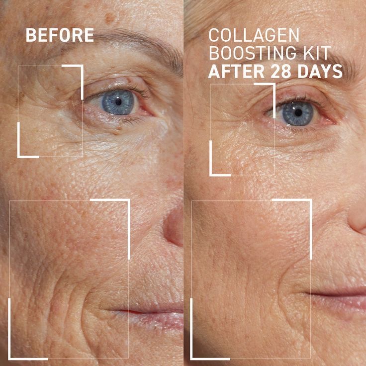 LANACRE - Collagen Boosting Before and After 28 Days